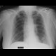 Metastatic lung disease: X-ray - Plain radiograph